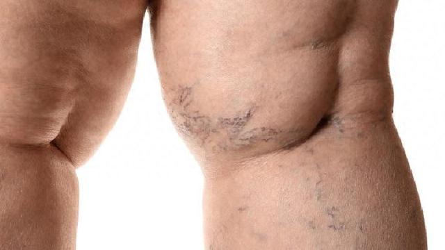 一个治疗静脉曲张的方子，用了20年，100个人，98个人都好了