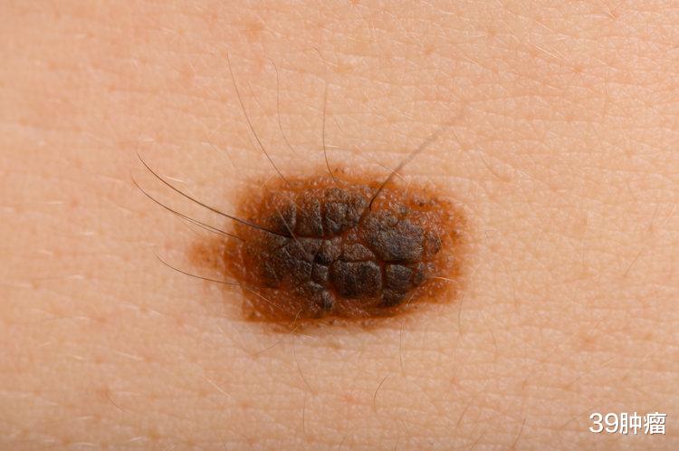 一再提醒：痣长在这3个位置，与癌症“密不可分”，赶紧自查