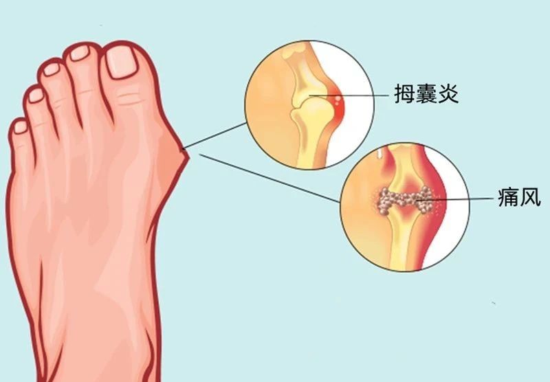 喝水越多，排出的尿酸就越多？医生劝告：缓解痛风，这几点很关键