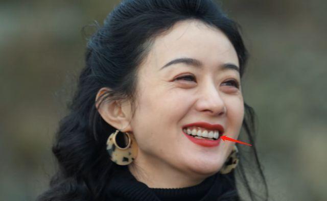 嘴包不住牙,牙龈萎缩发黑,明星假牙后遗症终于藏不住了!