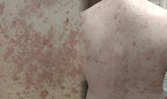 牛皮癣是不死癌症?1块钱的中药泡水,帮助把皮损“吊打”消灭