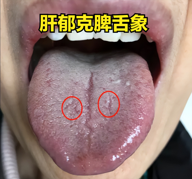 肝郁导致的海绵体软短,柴胡疏肝无效?只有健脾 清湿热 化瘀可解!
