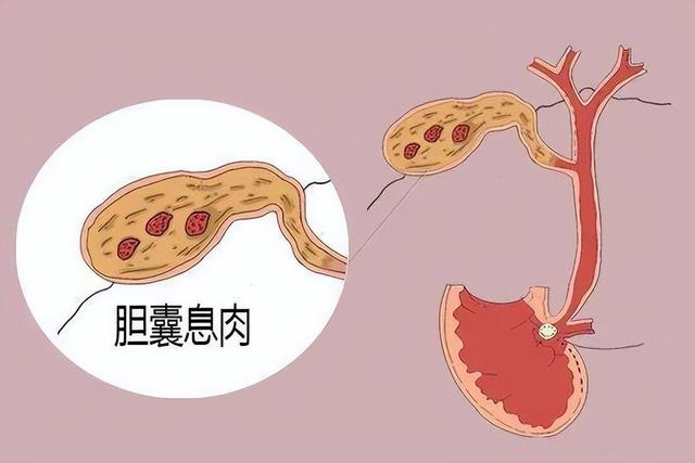 胆囊炎、息肉，恶心呕吐，老中医一招改善！疏肝利胆，包块小得快