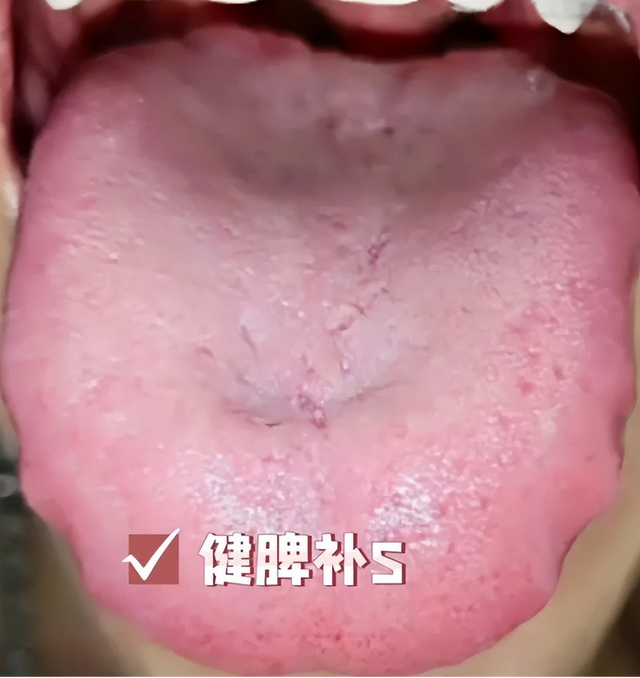 潘医生舌诊—实战分析：心肝火旺，脾肾两虚，湿气重