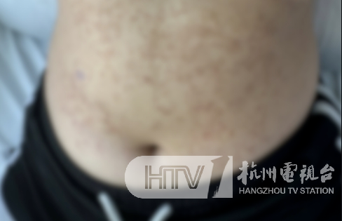 密密麻麻发满红疹…姑娘小伙都有中招！医生：赶紧停掉！