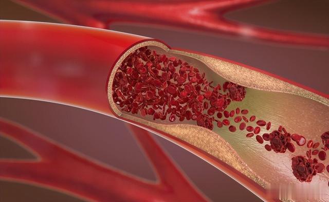 脚上一旦出现这种现象,是在提醒你:有血栓了,及时检查制止