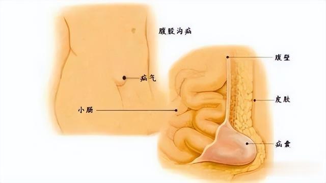 37岁男子因健身时用力过猛，“肠管”掉了出来！瞎练？