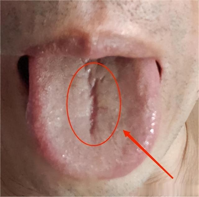 舌头有裂纹，吃一筐健脾丸都没用！教你1招，搞定裂纹舌！