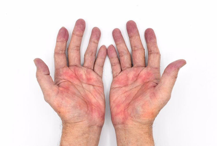体内有癌，双手知道？提醒：手部若有3个异样，可能是癌症在走近