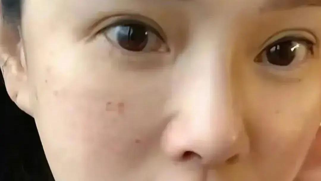 56岁伊能静跑去韩国打水光！素颜出镜，满脸针眼，并坦言真的很痛