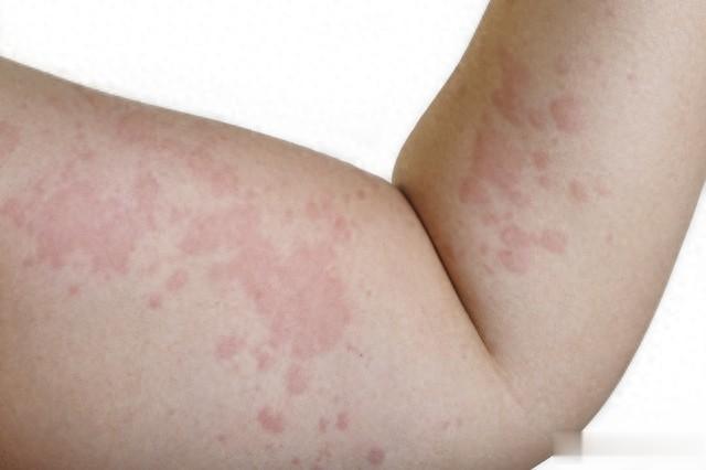 张志远教授脱敏良方：麻黄连轺赤小豆汤的创新应用