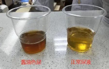 超出正常值400倍!20岁小伙健身两周,紧急就医