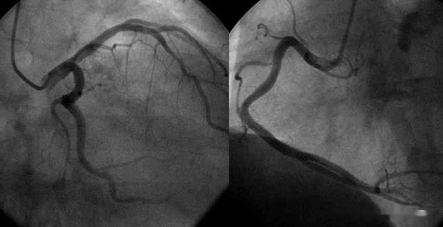 心脏冠状动脉斑块，狭窄从50%降到10%，怎么做到的？如何逆转斑块