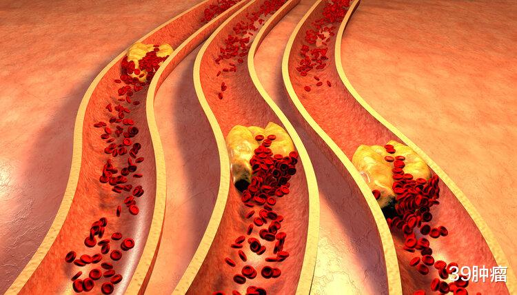 体内有血栓，手脚先知！手脚若有这5种表现，血管可能已经堵塞