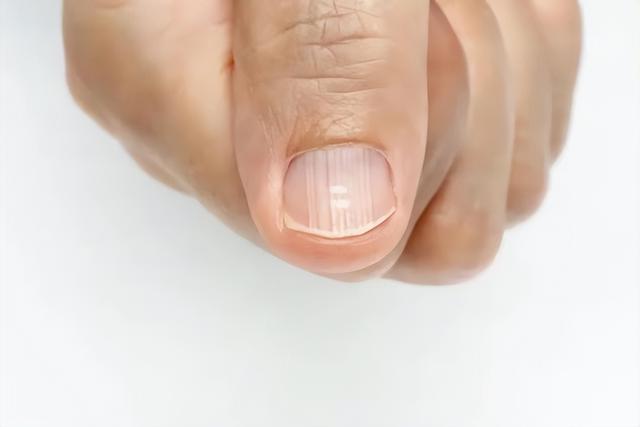 指甲上有竖纹？医生提醒：若指甲有这4种异常，要多注意