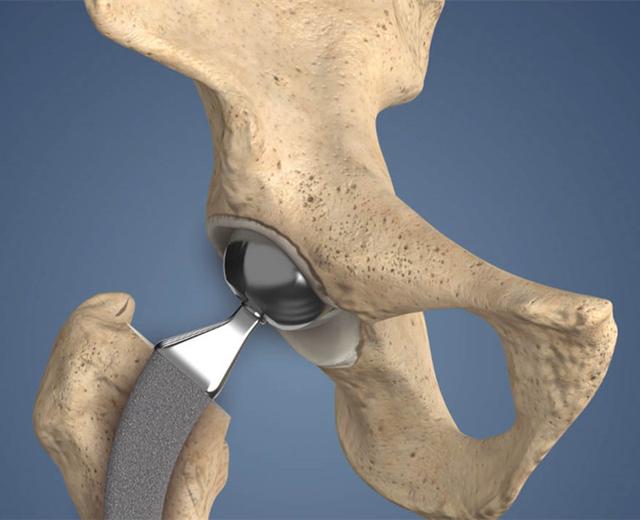 髋关节置换手术后,什么是最坏的动作,哪些运动不能做?