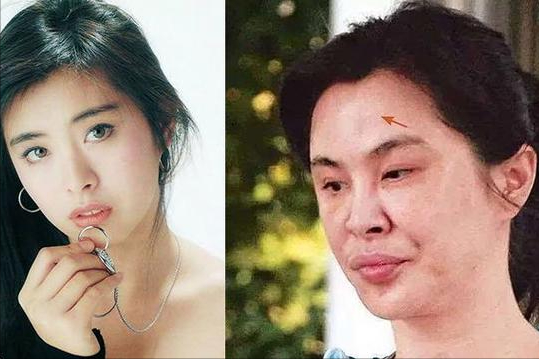 毁在医美的女星：彭丹像伏地魔，张檬“人身蛇脸”，王思懿认不出