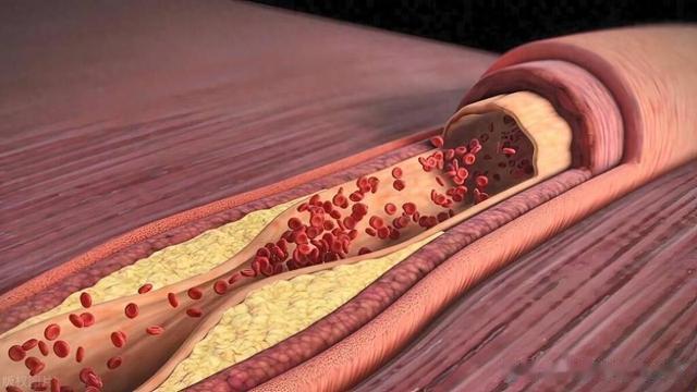 痰湿入血，血液就越来越稠，一方扫清痰湿，给血管做个大扫除