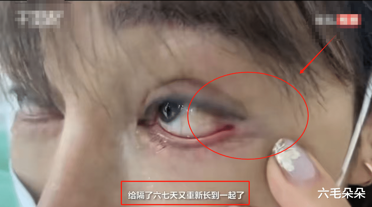 女子花3万割双眼皮，眼球与眼尾被缝一起无法转，整形医院只赔1万