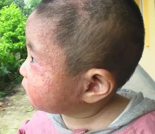 体内脏腑有“毒”,湿疹就不容易除