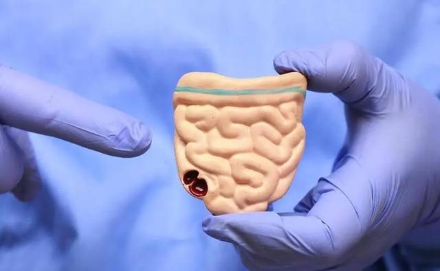 48岁大哥确诊结肠癌，崩溃痛哭：腹部早有“信号”，是我轻视了