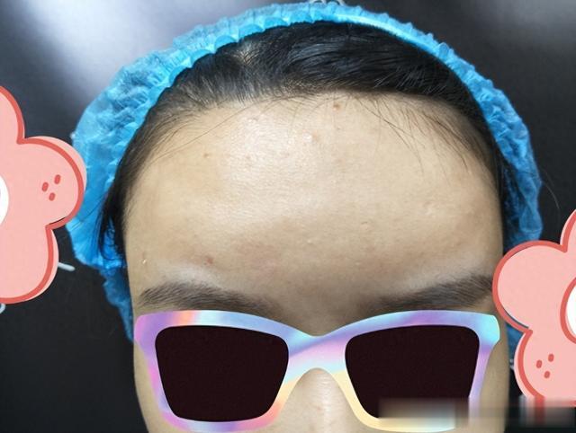 25岁女生额头脂肪填充失败后凹凸不平，修复后恢复平整