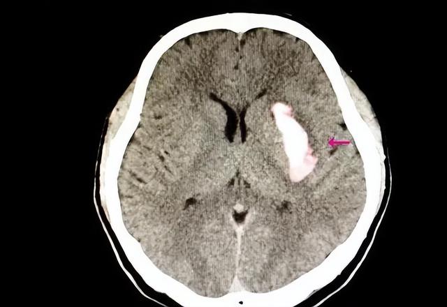 血压多高，会发生脑出血？医生直言：最好不要超出这个数值