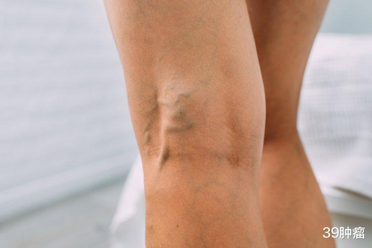 体内有血栓，手脚先知！手脚若有这5种表现，血管可能已经堵塞