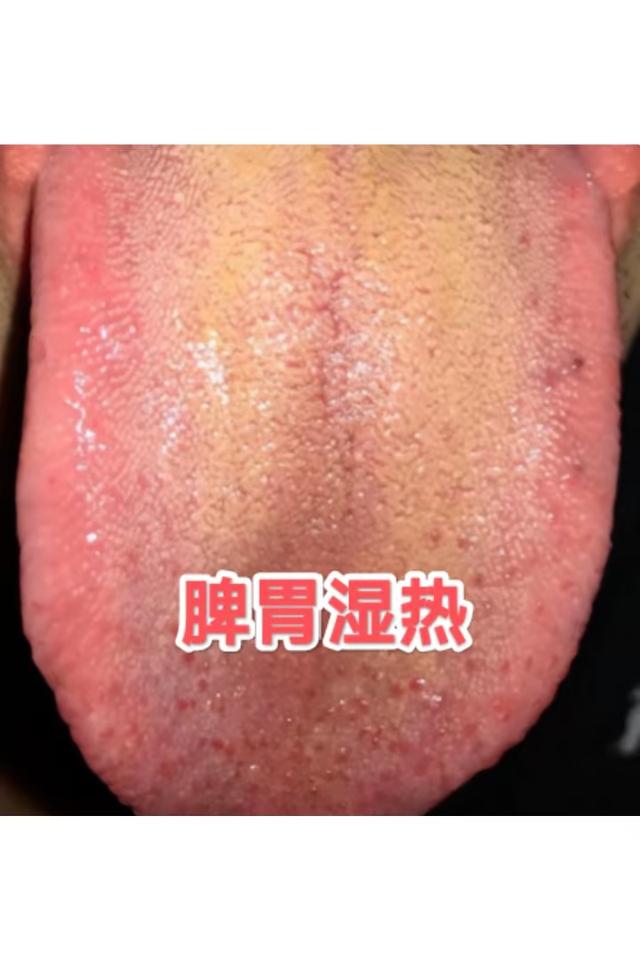 舌诊案例——30S辨别寒湿、痰湿、湿热！内附三名方 横扫一身湿邪