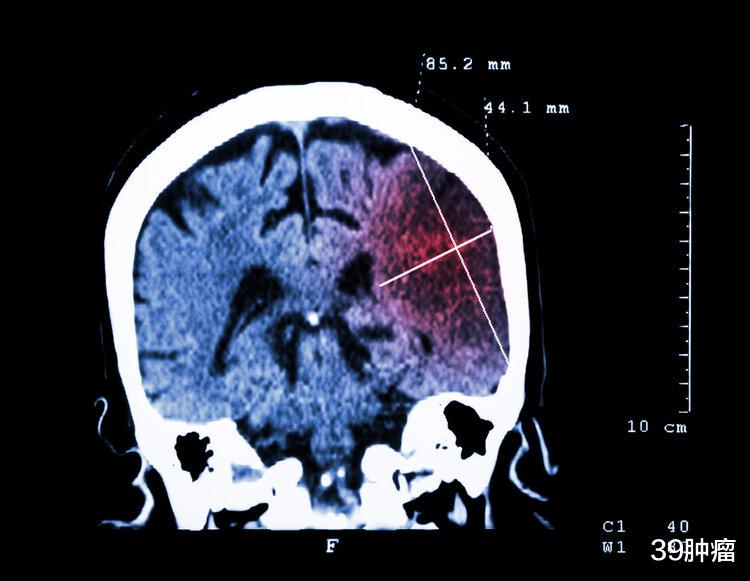 无端端有8种异常表现，十有八九是脑梗“求救”信号，尽早查CT