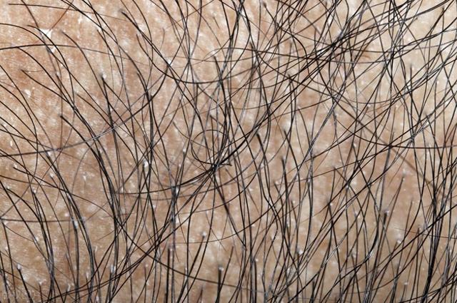 洗澡时“下面”的毛毛掉落很多,这是正常吗?其实原因有这几个