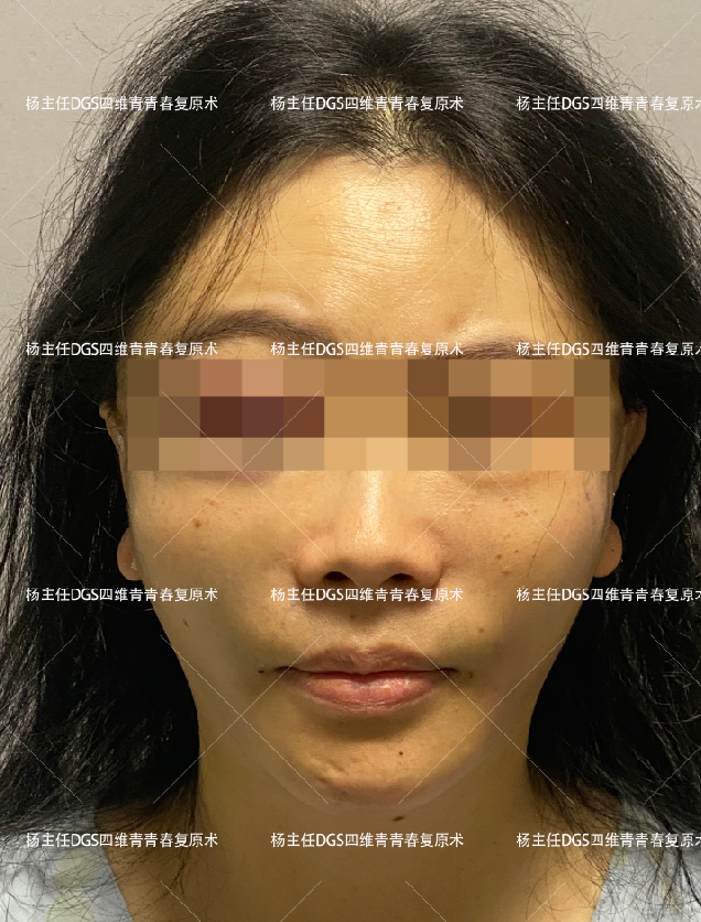 43岁女士，人生第一次做拉皮提升，术后60天，像换了一张脸！