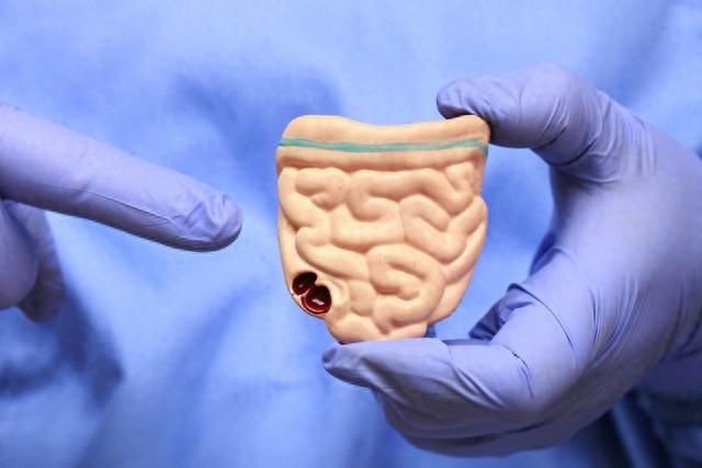 经常放屁代表体内有癌？出现这种气味的臭屁，务必尽早到医院检查