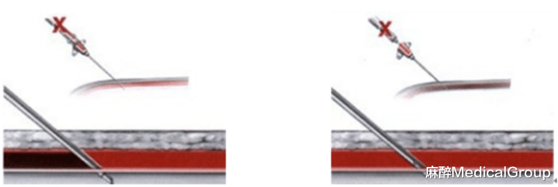 思维导图带你掌握动脉穿刺