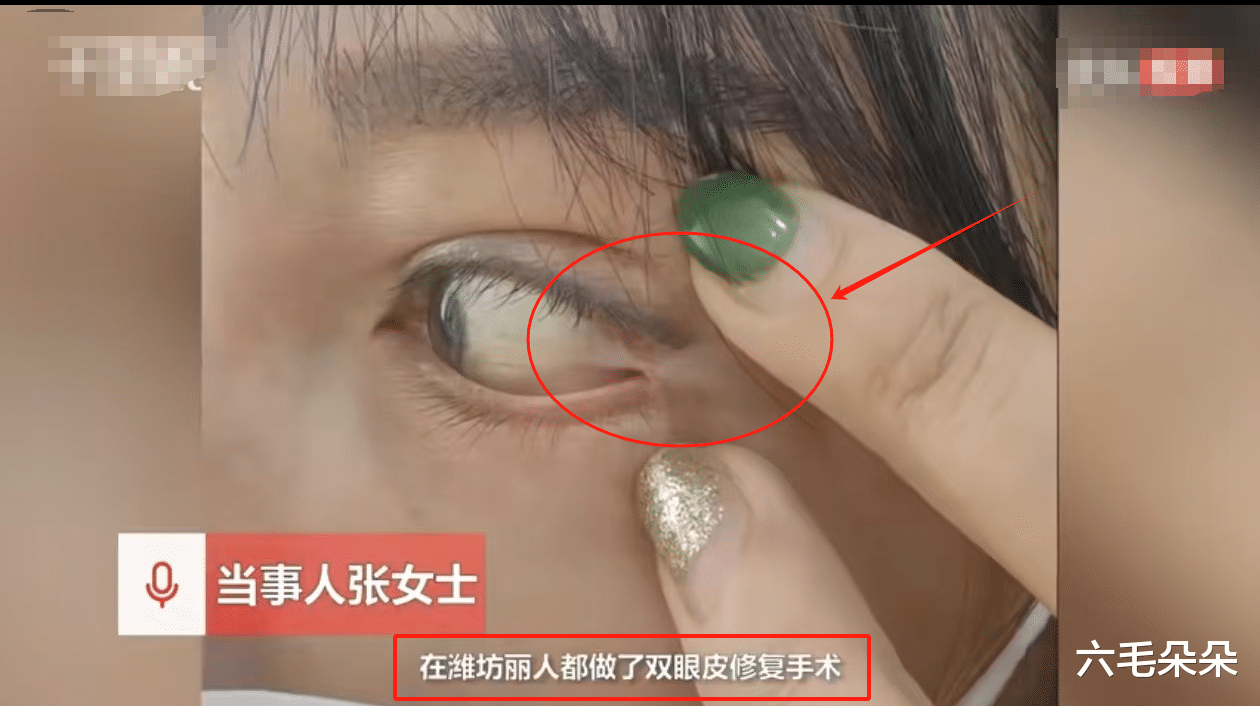 女子花3万割双眼皮，眼球与眼尾被缝一起无法转，整形医院只赔1万