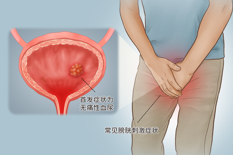 53岁男子确诊膀胱癌!他的“坏习惯”为所有人敲响警钟!值得借鉴