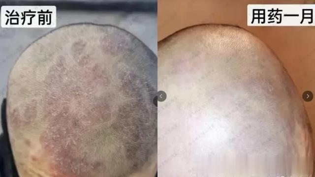 这个夏天，常吃1种豆，牛皮癣不再“牛”！