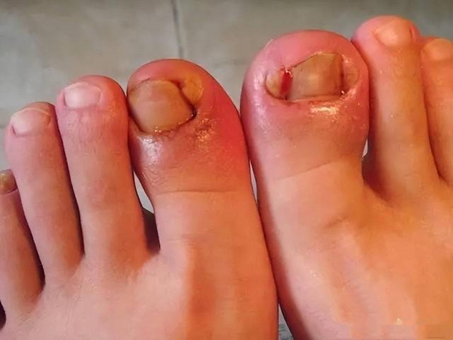 为啥说甲沟炎就如酷刑似的?看完医生解释,隔着屏幕都感到疼痛