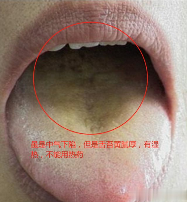 脂肪越来越多，宗筋也莫名发软，这种痰湿舌象，还好有这个方子！