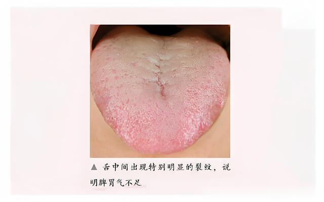 虚汗、自汗、满头大汗，玉屏风散这样搭，益气固表，敛汗止汗