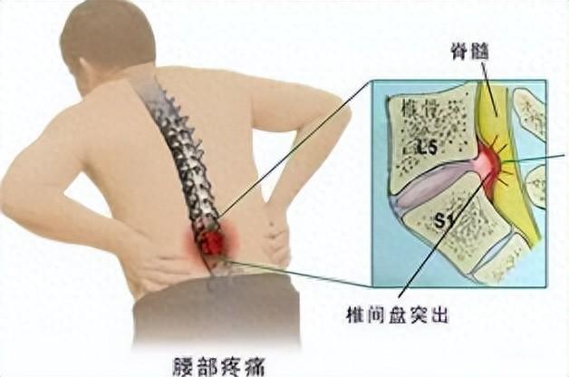 肢体麻木就是骨头出了问题？一个中成药，赶走麻木