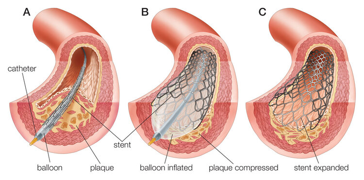 国内将停止“心脏支架”手术？做完人就废了？一次性告诉您真相