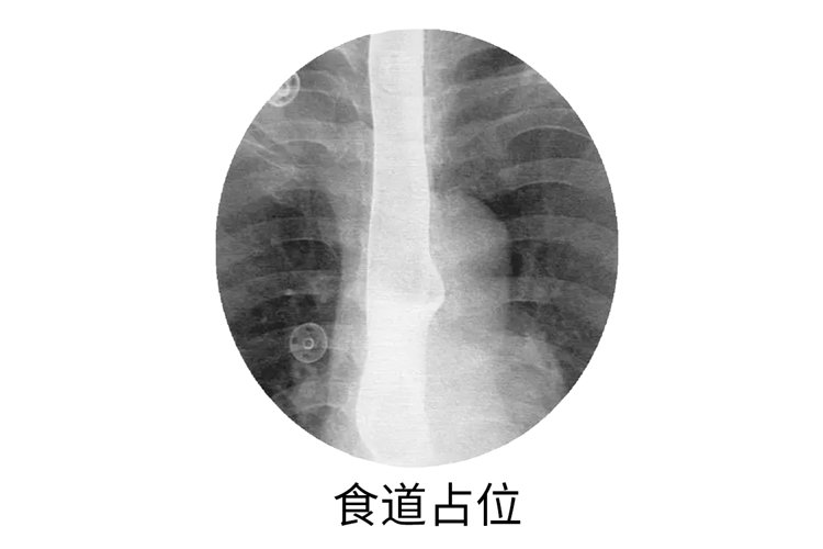 体检报告上这几个字提示可能是癌，医生不方便说，但是你得知道