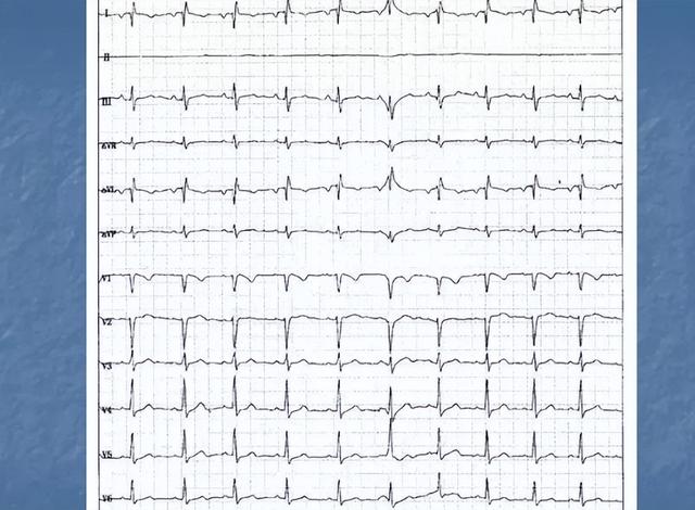 数名医生研究：心率不超过这个值，不用担心猝死，放宽心吃好睡好