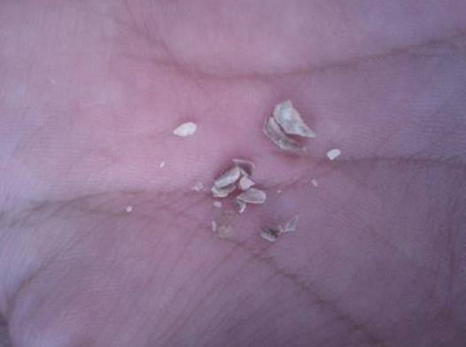 牙齿上长出“小石头”，味道又臭又硬，闻一下差点吐了