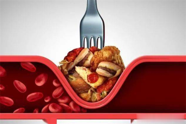 心脏冠状动脉斑块，狭窄从50%降到10%，怎么做到的？如何逆转斑块