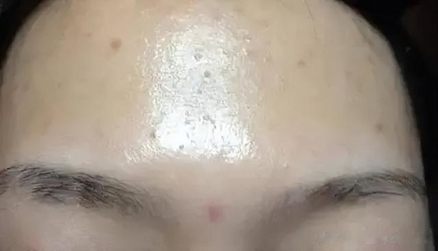 祛湿方鼻祖—苓桂术甘汤，健脾+祛湿，轻松解决5种问题