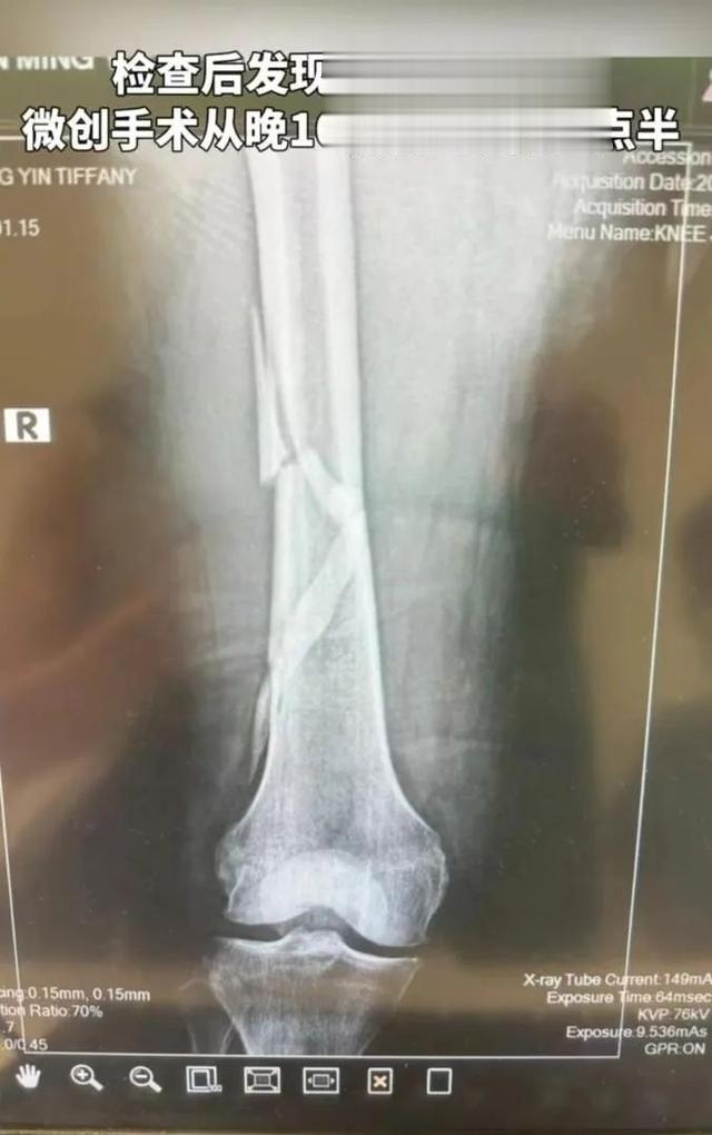 知名男演员自曝,除夕夜发生意外!医生紧急提醒→