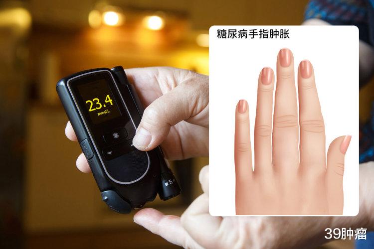 睡觉时出现这6个迹象，说明你的血糖高了！很多人都不知道