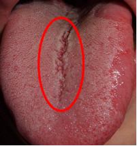 大错特错!裂纹舌不光是脾虚,1次性教会你,通过裂纹找病根!